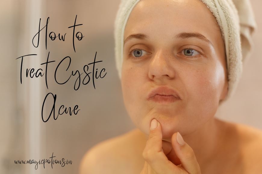 How to Treat Cystic Acne