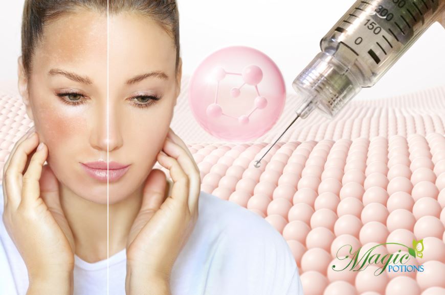 Can Skin Whitening Injections Help with Dark Spots and Pigmentation